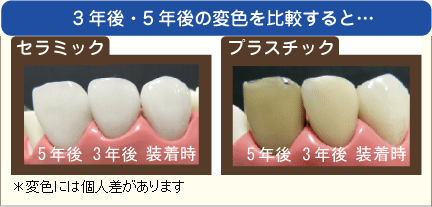 3年後・5年後の変色の比較